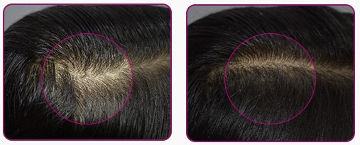 ボントレスプロ+スカルプセラムBeforeAfter