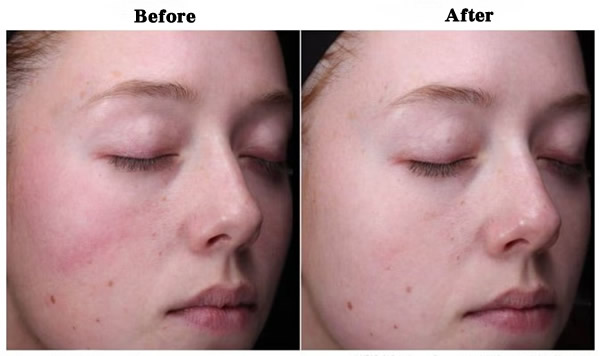 Revision Skincare Radiance+ Resurfacing Serum BeforeAfter