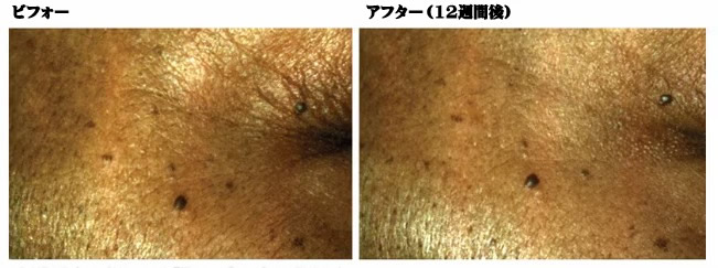 リボックス スキンスムージングセラム ビフォーアフター