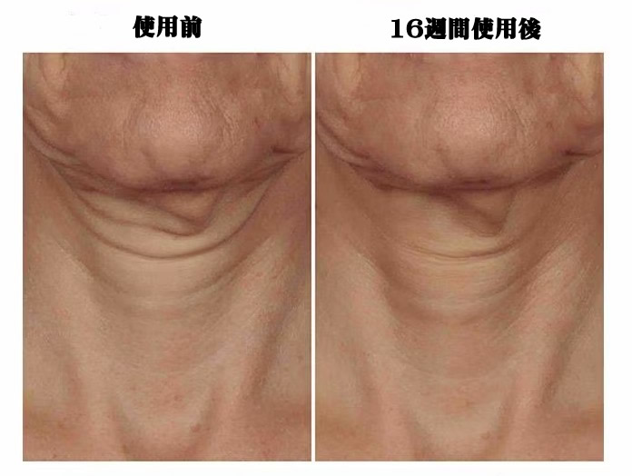 TriPeptide-R_Retinol_NeckRepair＿BeforeAfter