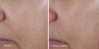 C+ コレクティングコンプレックス 30%のBeforeAfter